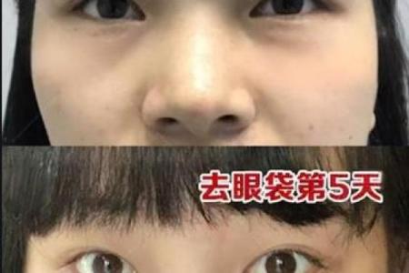 八字眼袋
