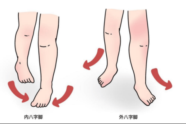 八字脚是什么