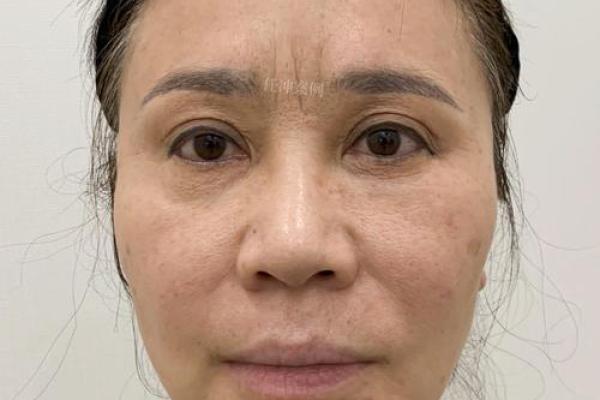 眉间八字纹消除