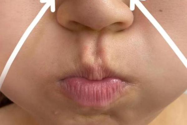 怎么去八字纹 怎么去八字纹