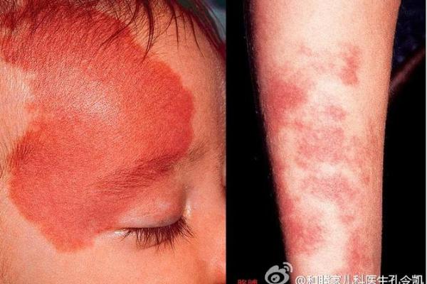 红色胎记算命图解