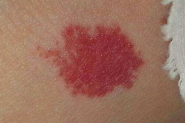 红色胎记算命图解