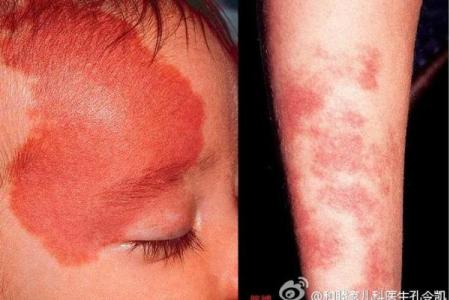 红色胎记算命图解