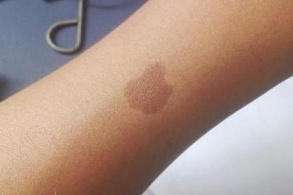 据脖子上胎记算命，有什么说法