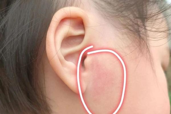 耳朵上的胎记算命分析