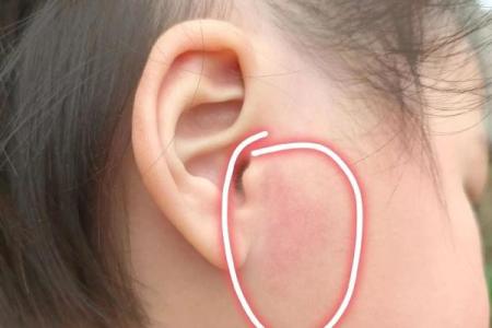 耳朵上的胎记算命分析