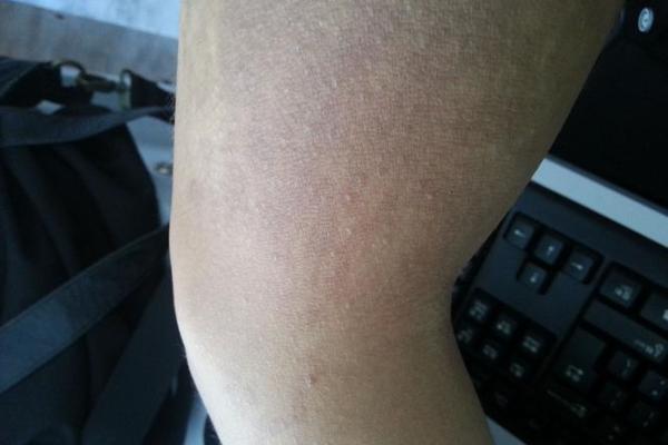 胳膊胎记可以算命吗- 胳膊胎记可以算命吗-