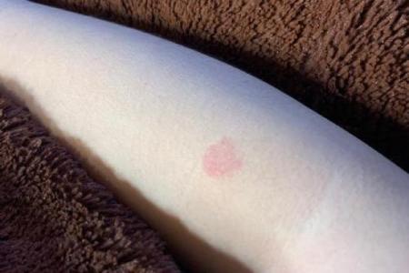 胳膊胎记可以算命吗-