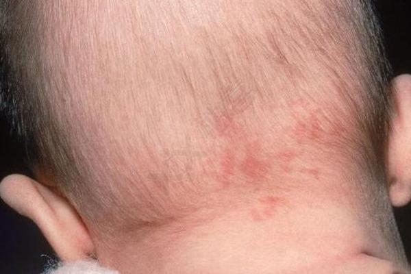 屁股上有胎记算命分析