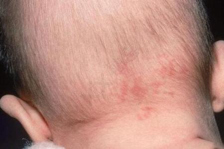 屁股上有胎记算命分析