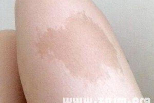 通过胎记算命能够读出人们身体上一些信息 通过胎记算命能够读出人们身体上一些信息