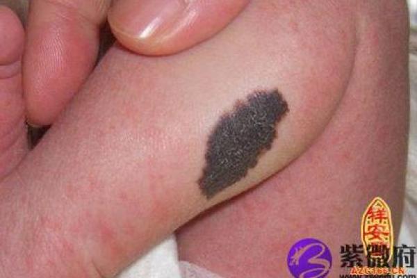 胎记算命胎记的位置与命运