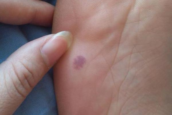 如何根据背部胎记算命- 如何根据背部胎记算命-