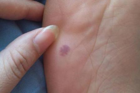 如何根据背部胎记算命-