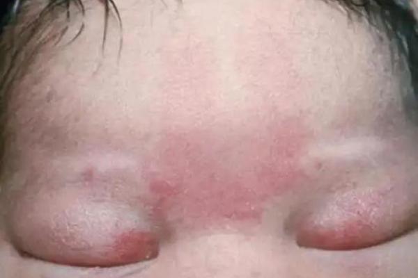 红胎记算命图解 红胎记算命图解