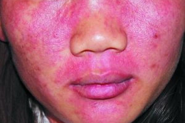 红胎记算命图解 红胎记算命图解