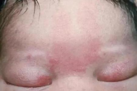 红胎记算命图解