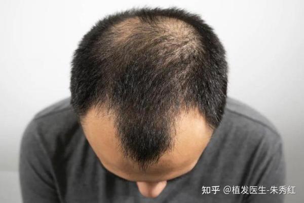 头发稀少的八字特征 八字头发稀少