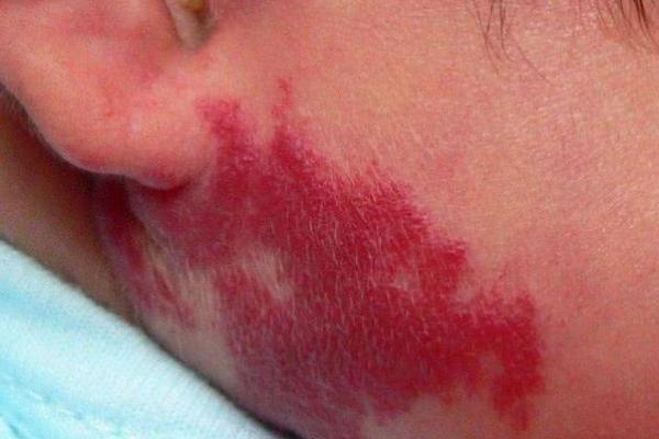 红色的胎记如何看相算命- 红色的胎记如何看相算命-