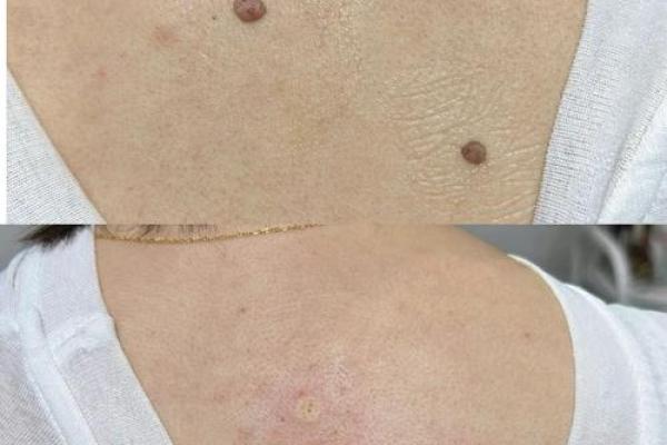 背上的痣图解算命