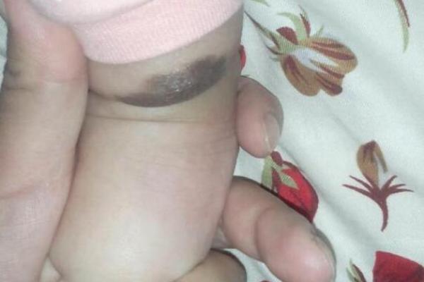 胎记释义，胎记算命中代表什么