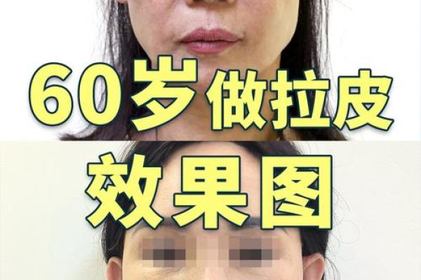 怎么消除八字纹 怎么消除八字纹