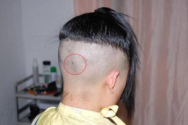 风水上后脑勺长痣代表什么意思