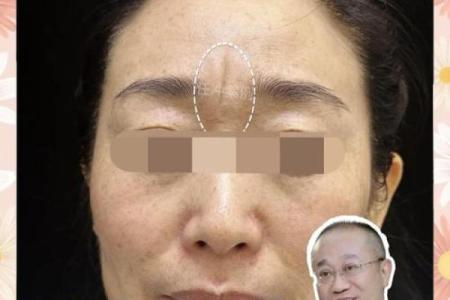 八字纹怎么去除