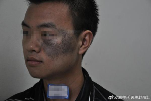 眼睛上的胎记算命分析 眼睛上的胎记算命分析